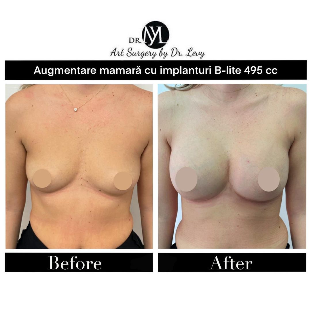 breast augmentation bucharest