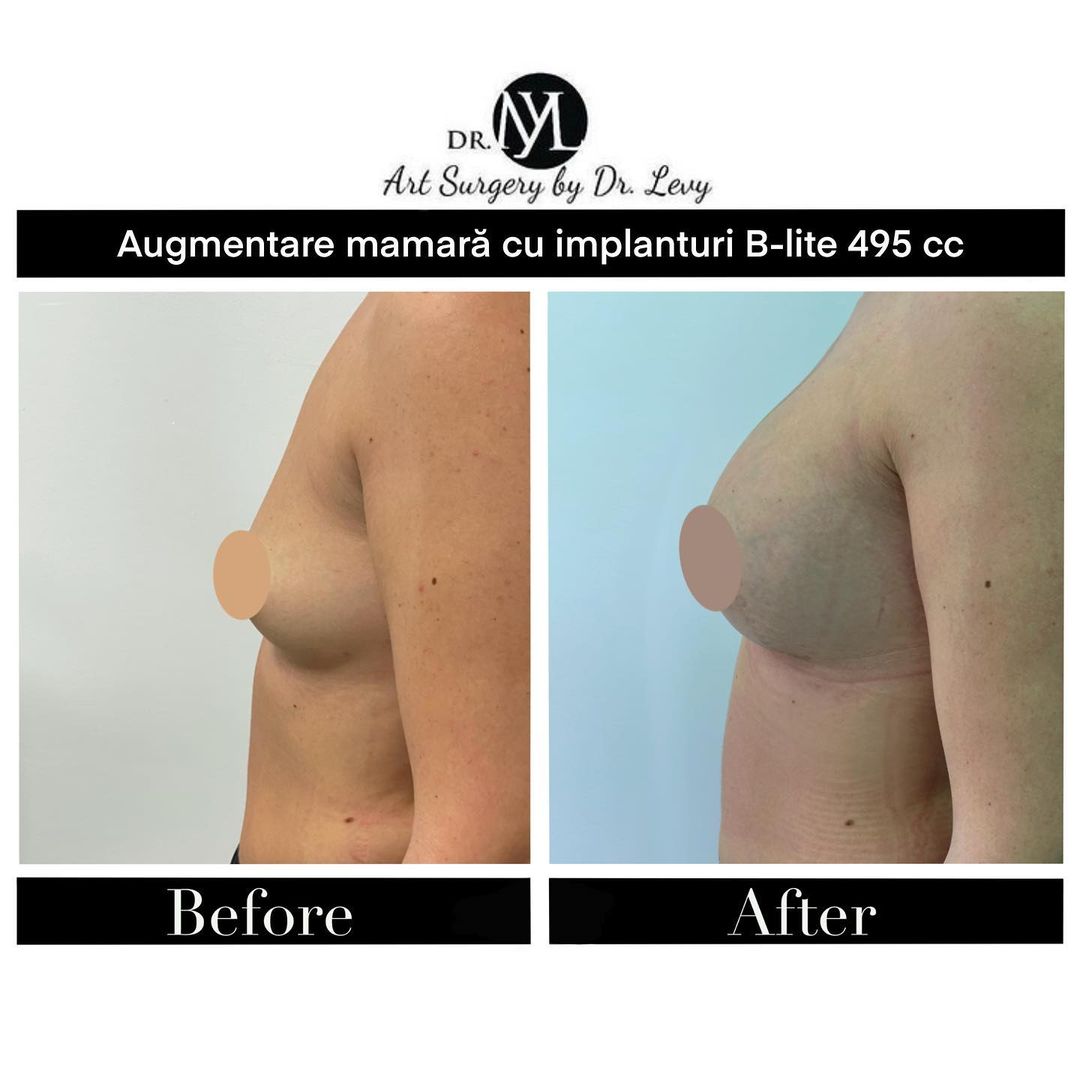 breast augmentation romania