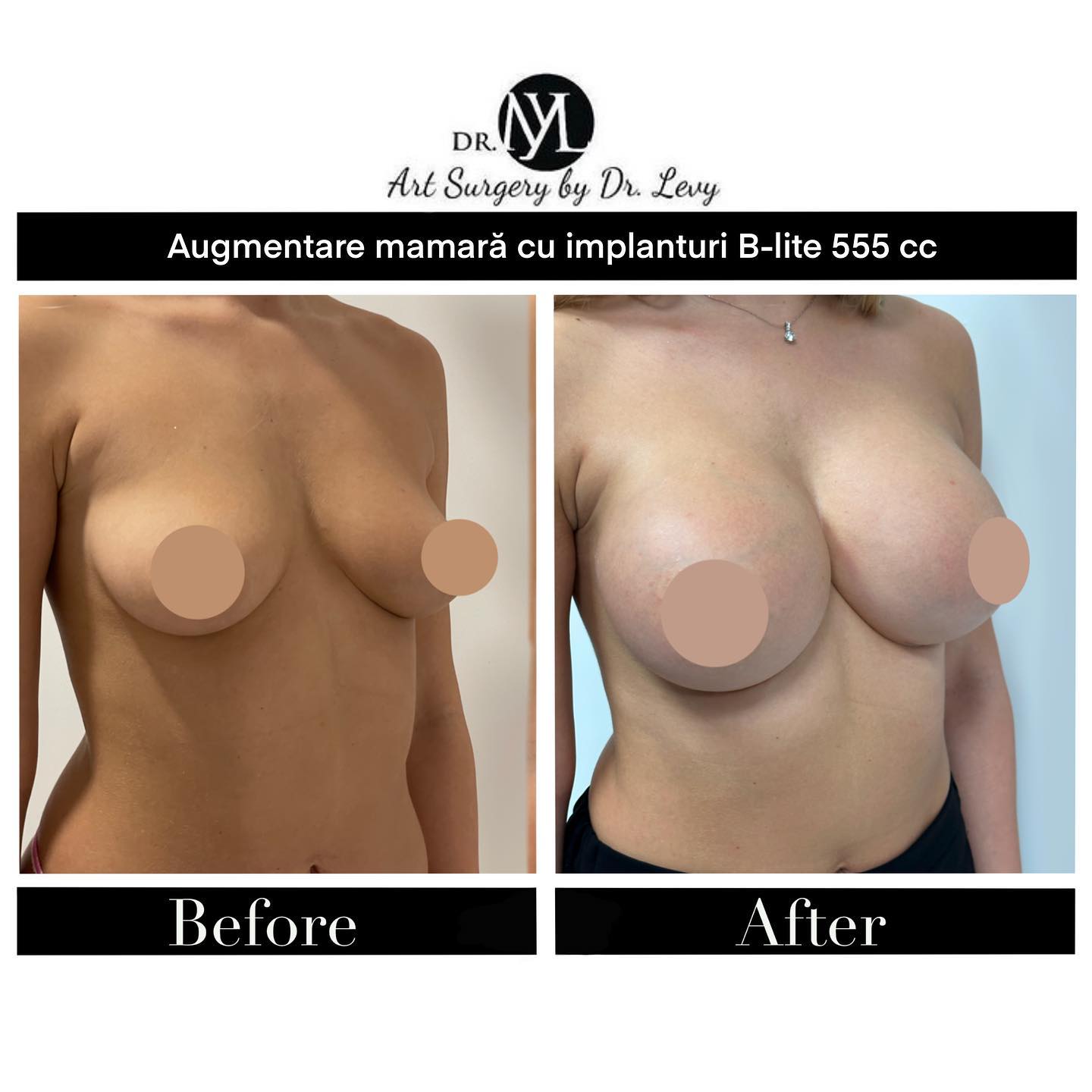 implante mamare romania