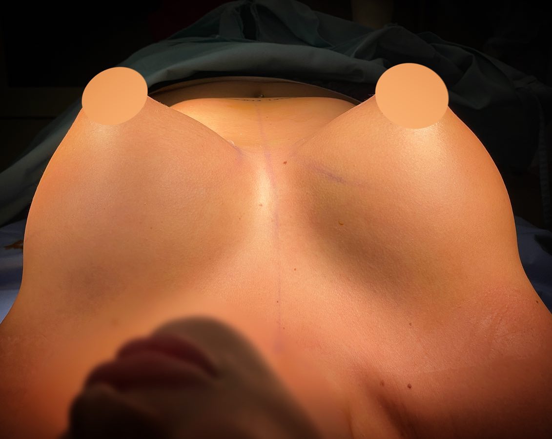 poze operatie implant mamar