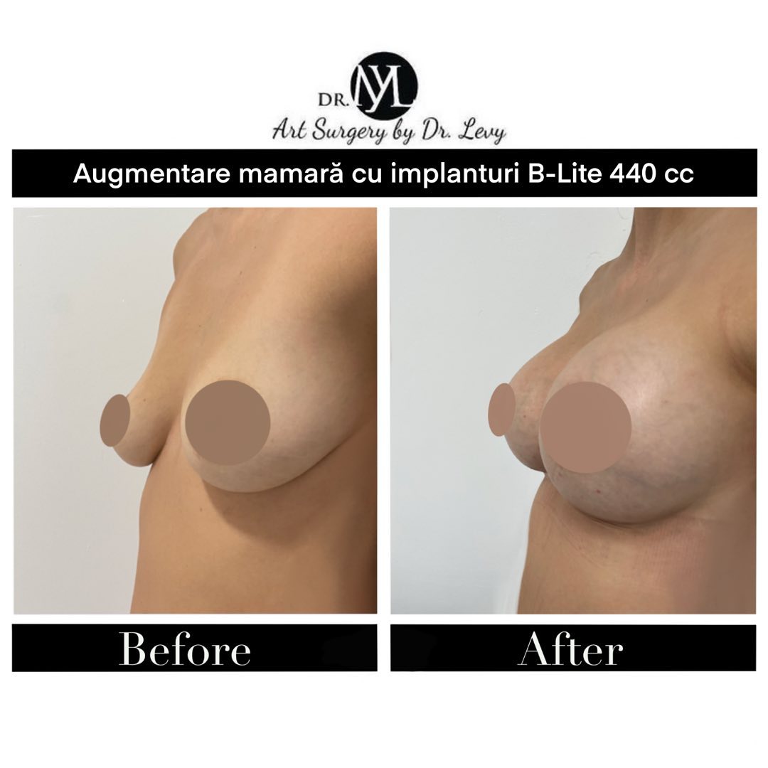implant mamar