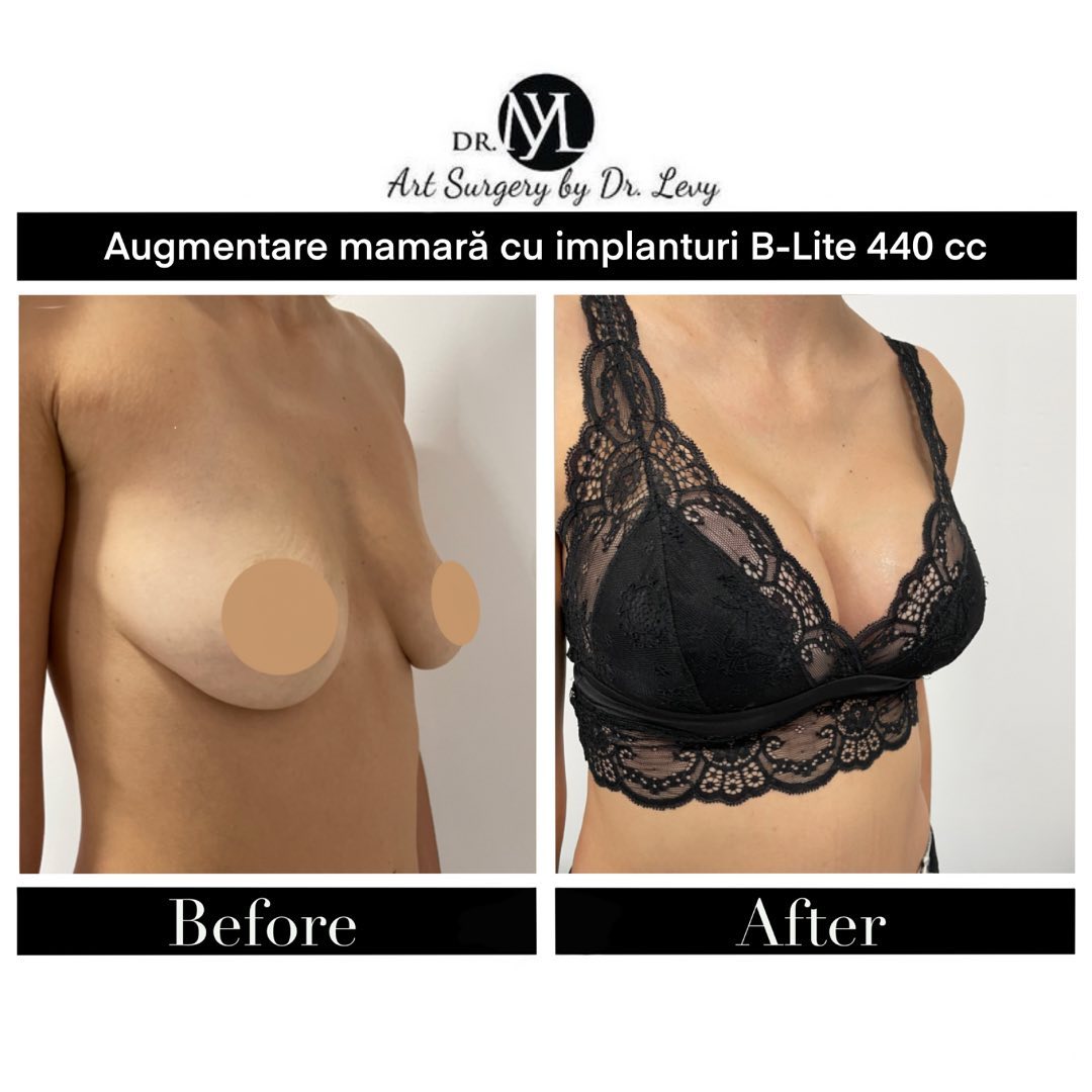 augmentare mamara cu implanturi 440 cc