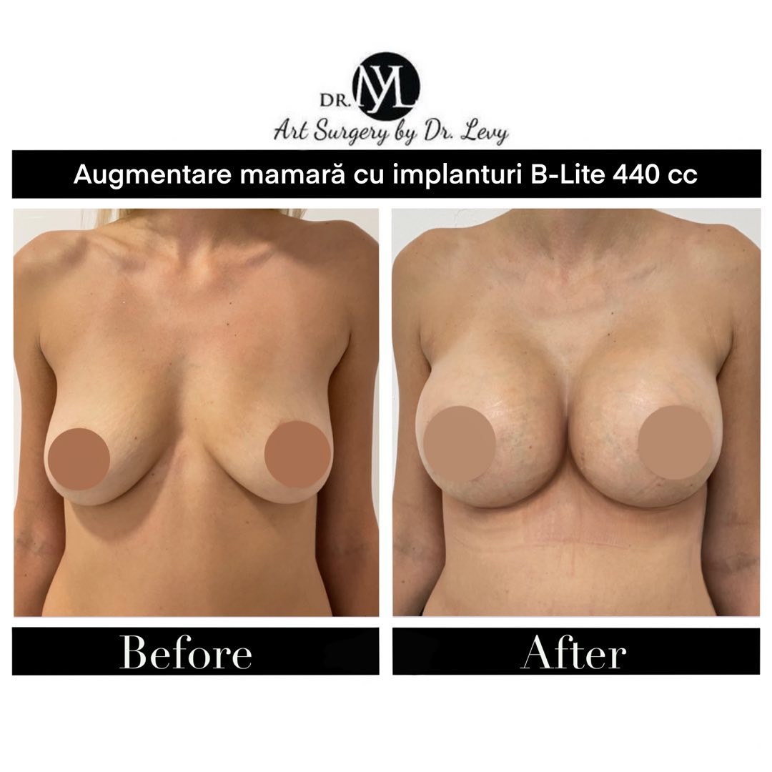 augmentare mamara implanturi 440 cc
