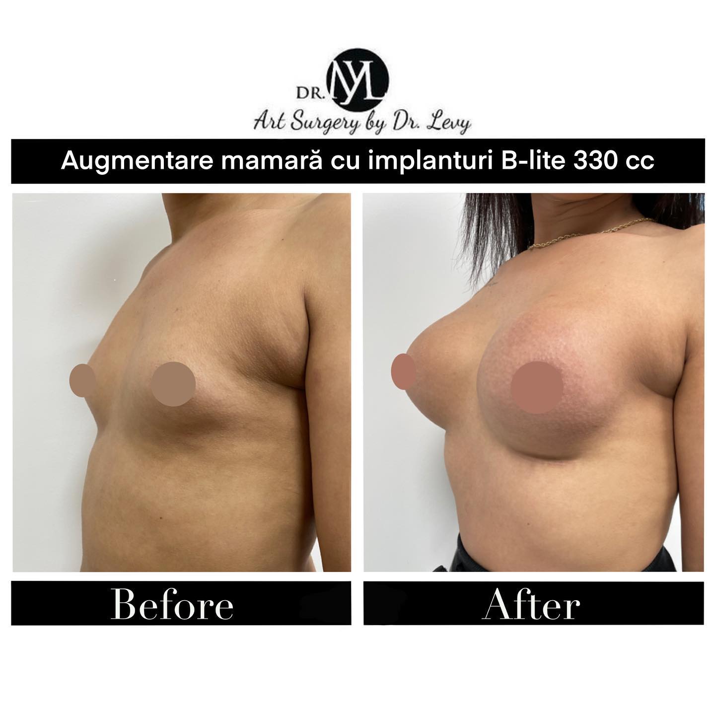 augmentare mamara cu implanturi 330 cc