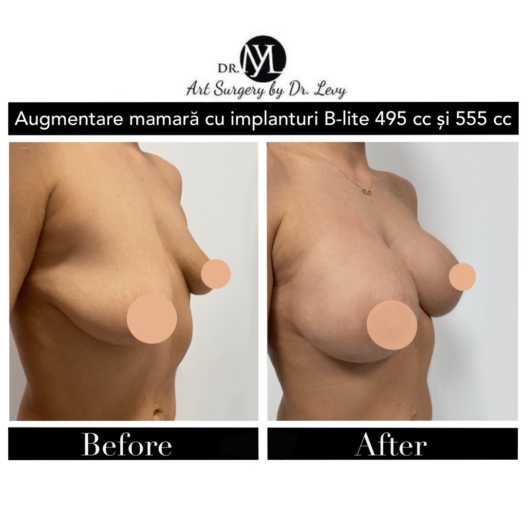 augmentare mamara cu implant