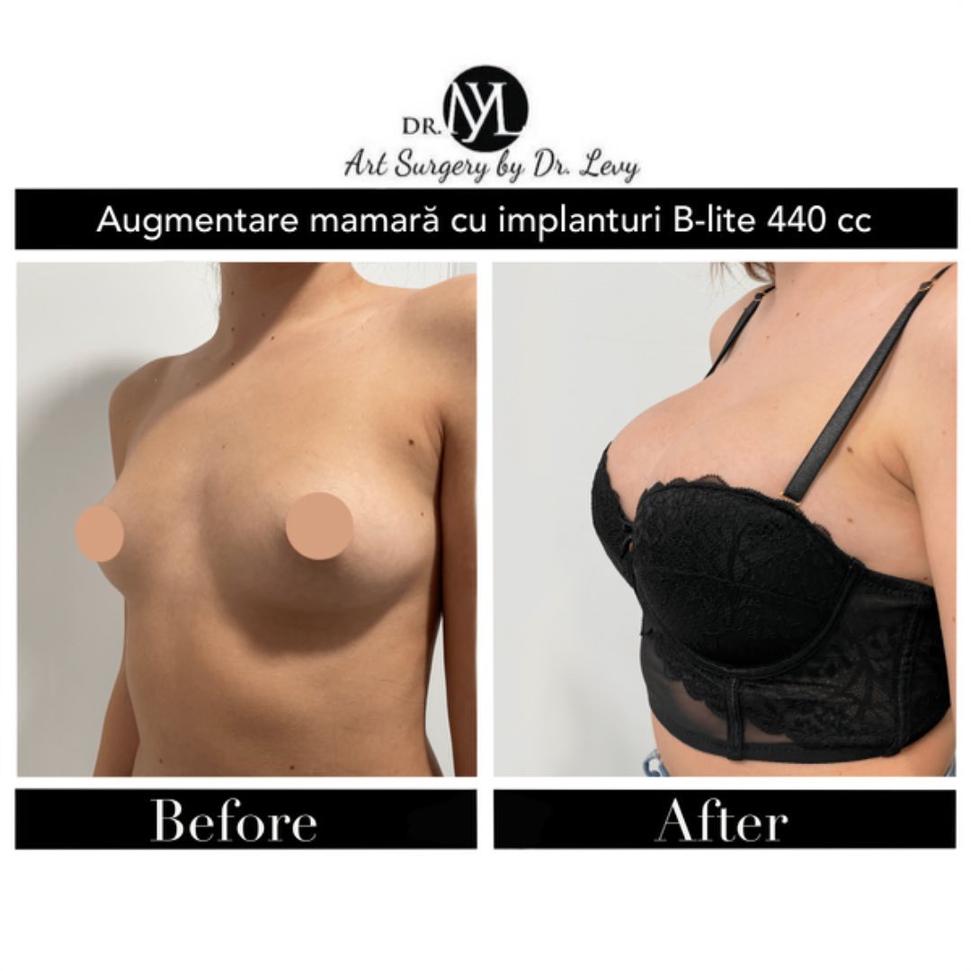 fotografii implante mamare bucuresti romania