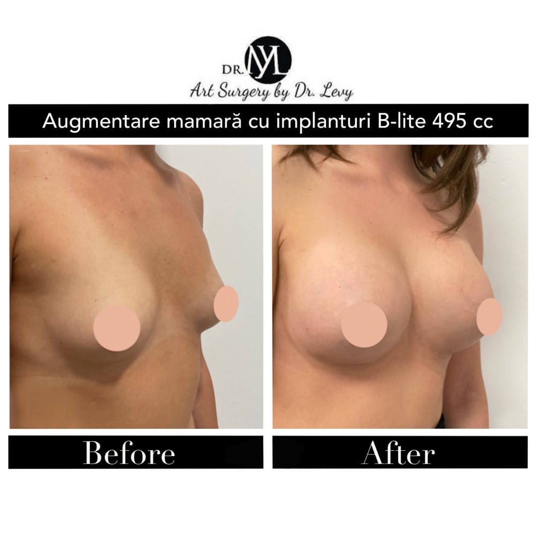implanturi mamare 495