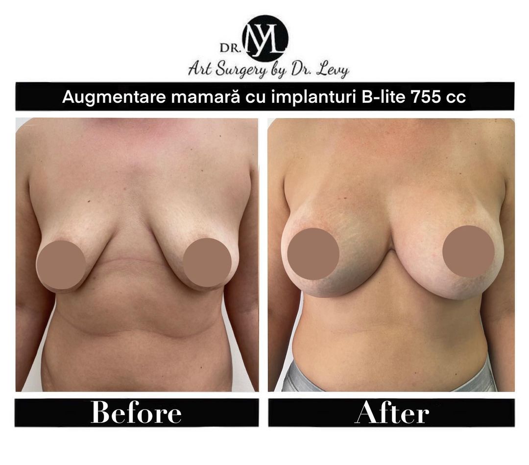 augmentare mamara cu implanturi mari 755 cc