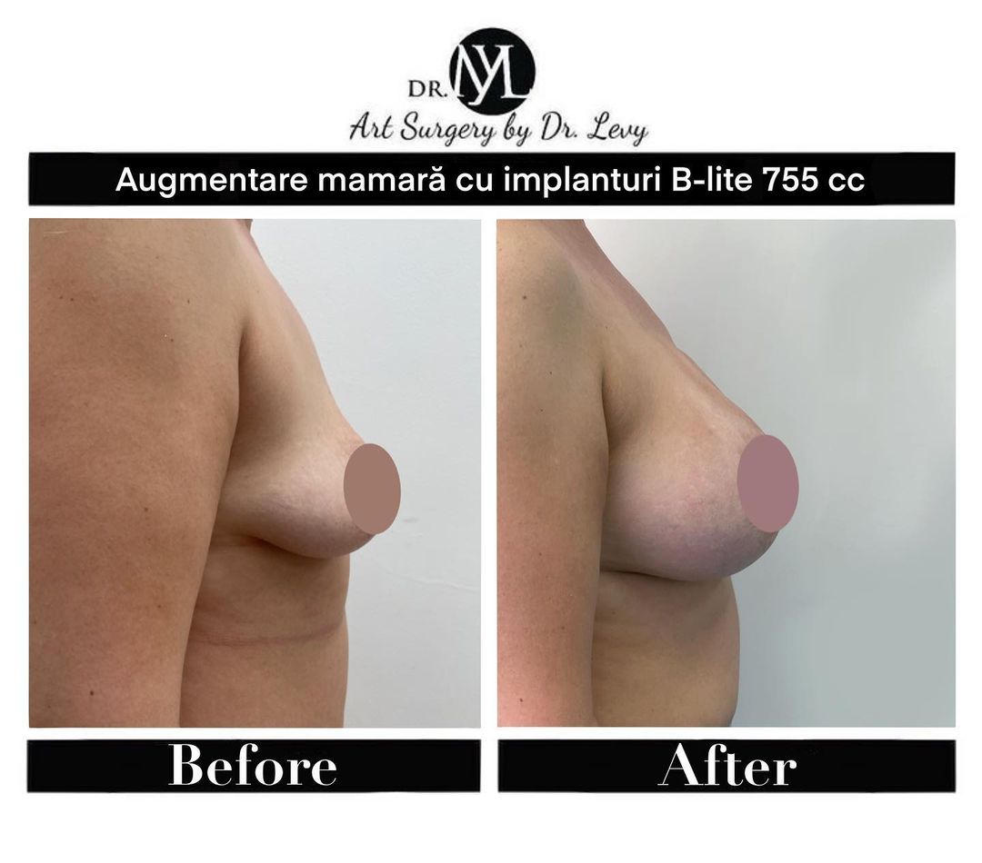 implant mamar silicoane 755