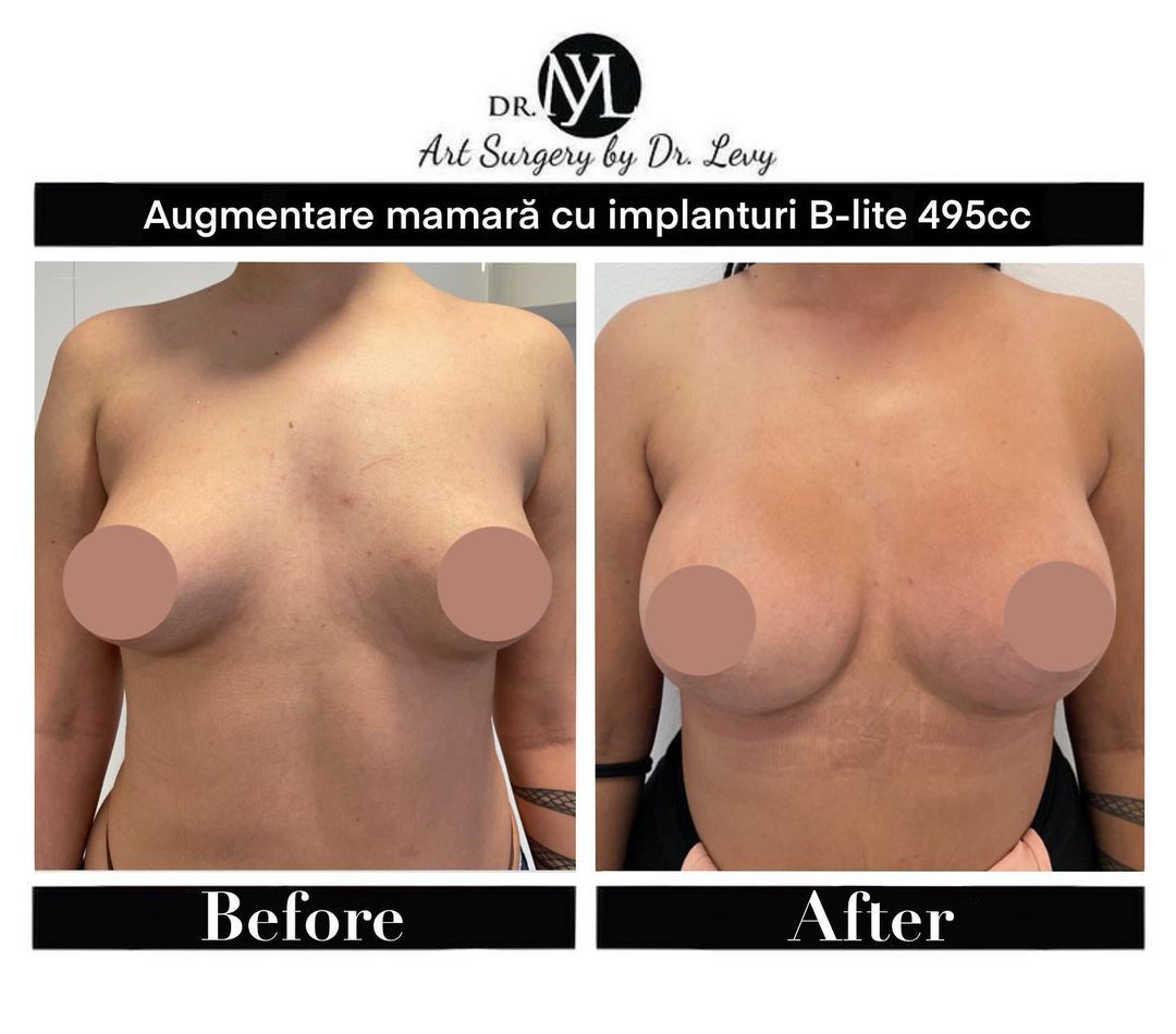 poze cu implante mamare