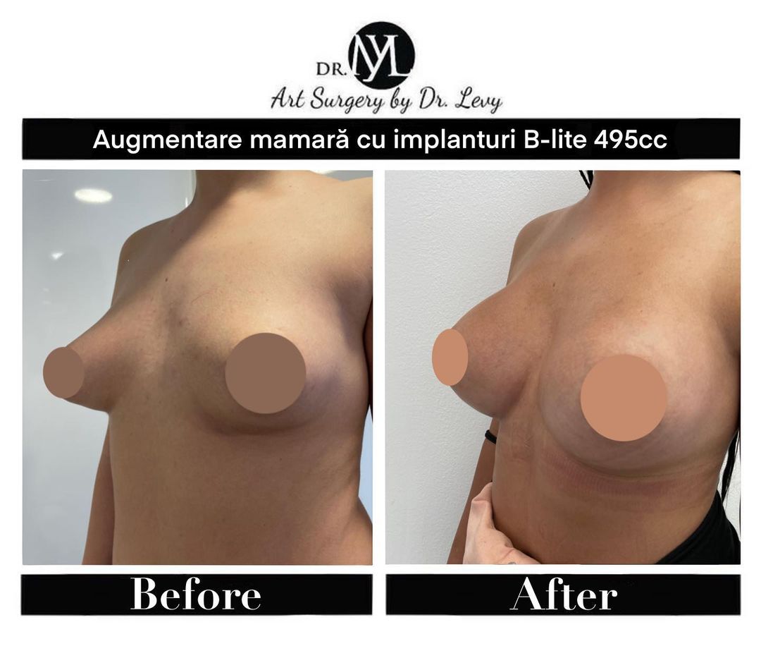 implante mamare