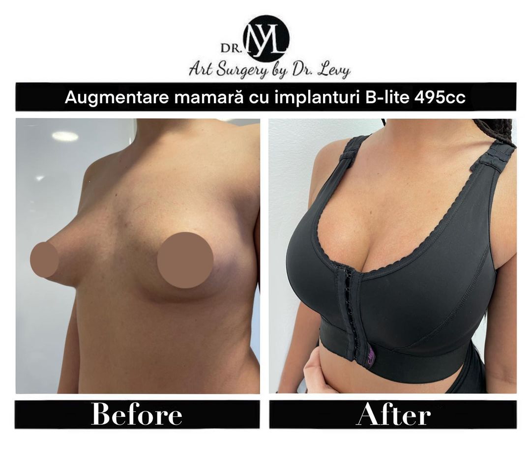 augmentare mamara sani cu implanturi 495