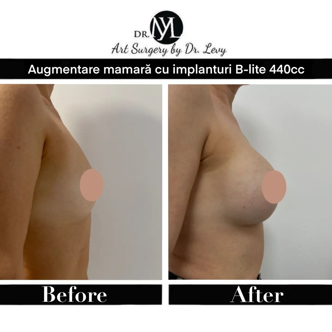 augmentare mamara cu implanturi b-lite 440 cc