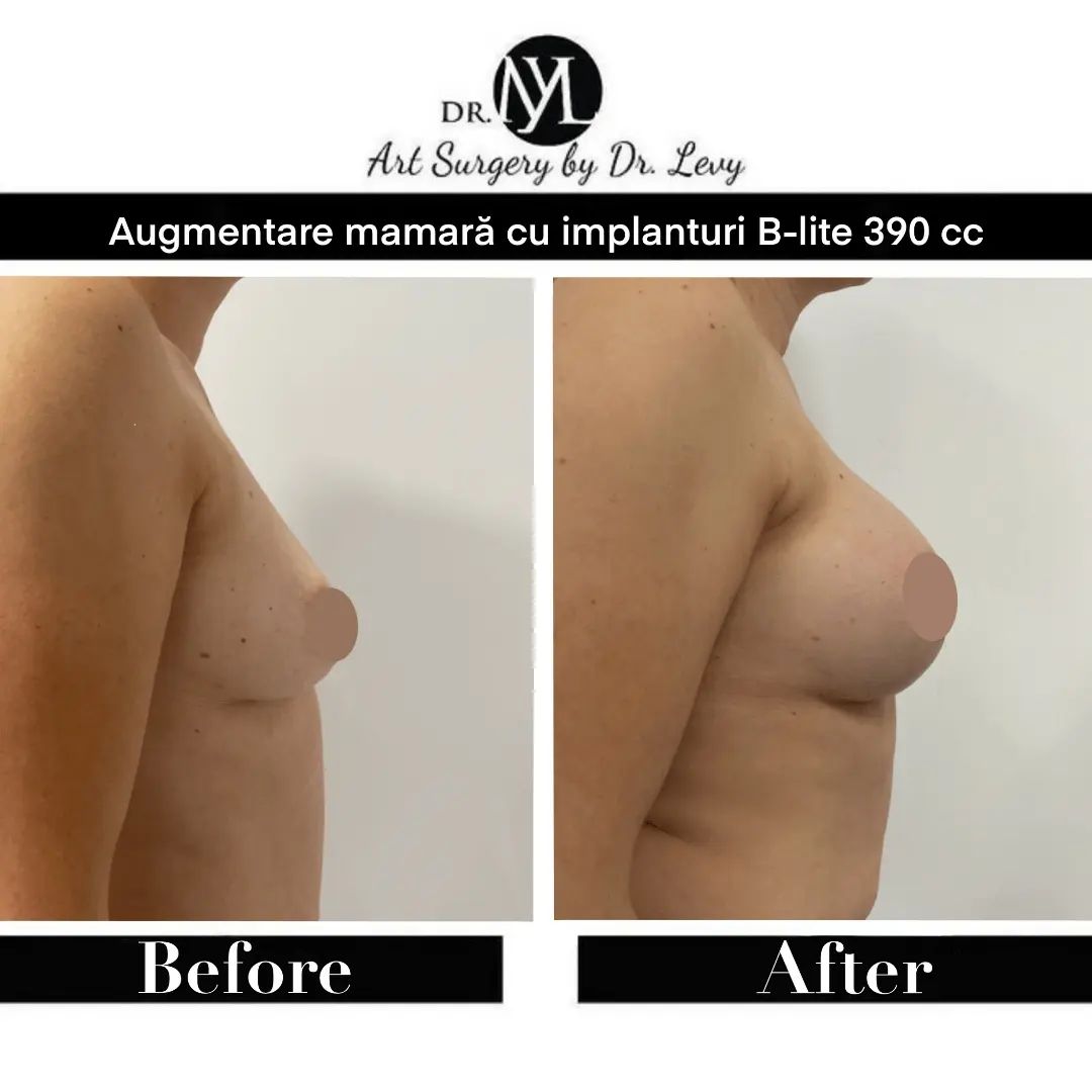 poze implanturi mamare