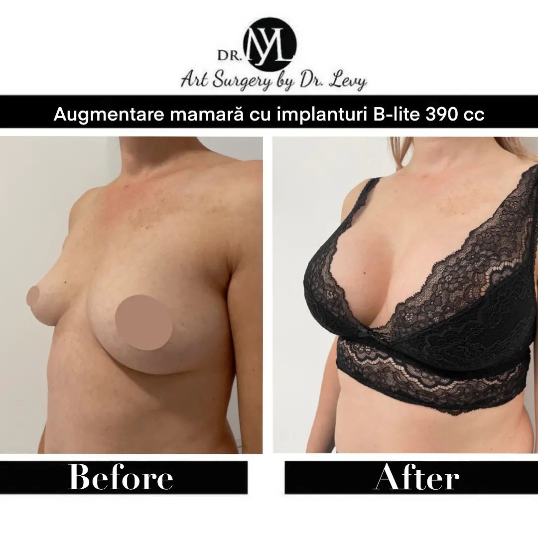 implant mamar augmentare sani 390 cc