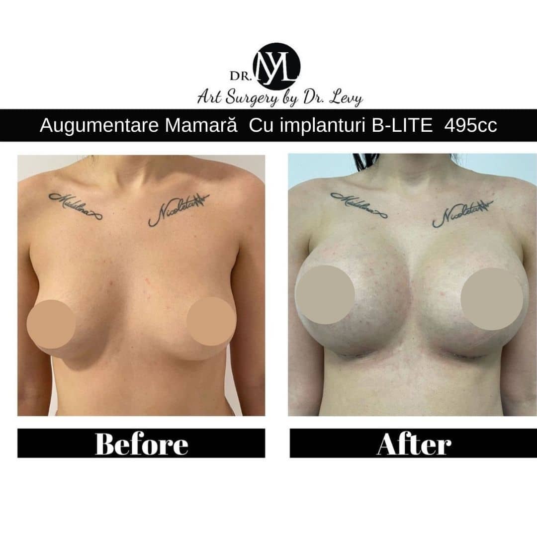 rezultat augmentare mamara cu implanturi b lite 495