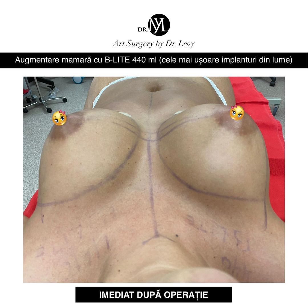 poza augmentare mamara cu implanturi silicon b lite 440
