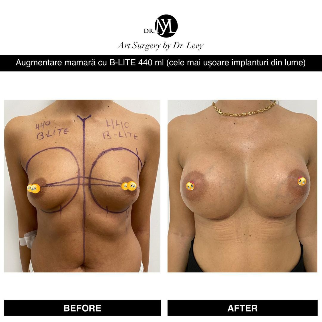 poze augmentare mamara implanturi silicoane 440