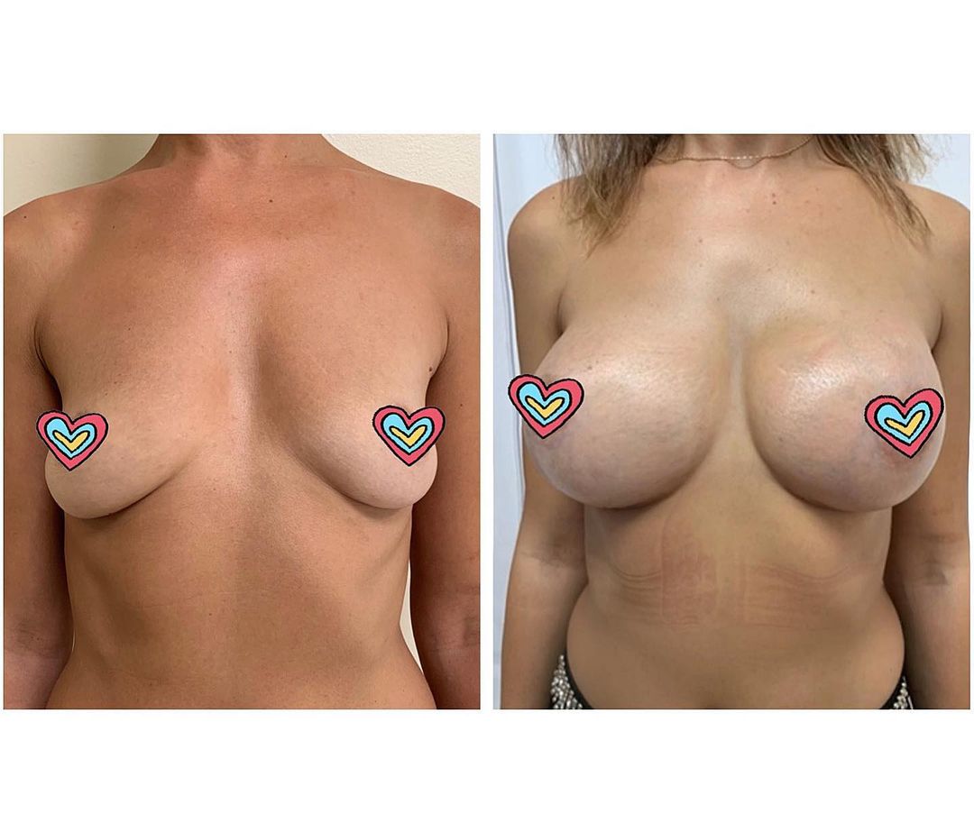 breast implants bucharest romania