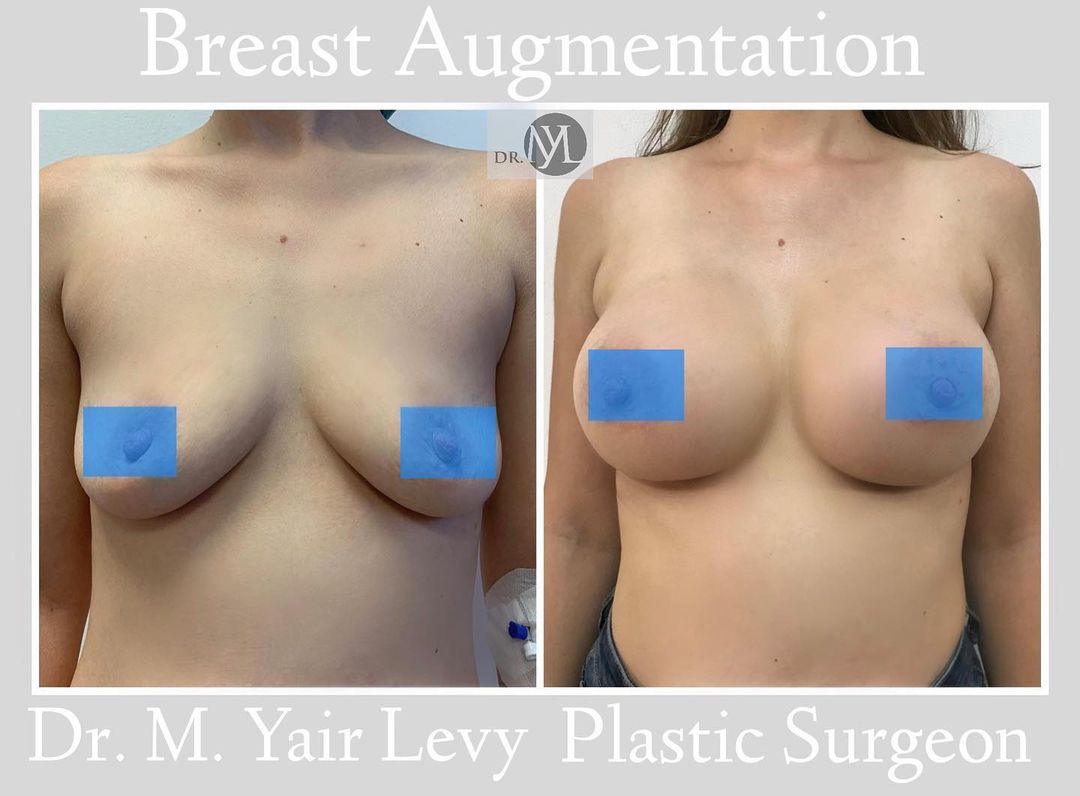 breast augmentation bucharest romania