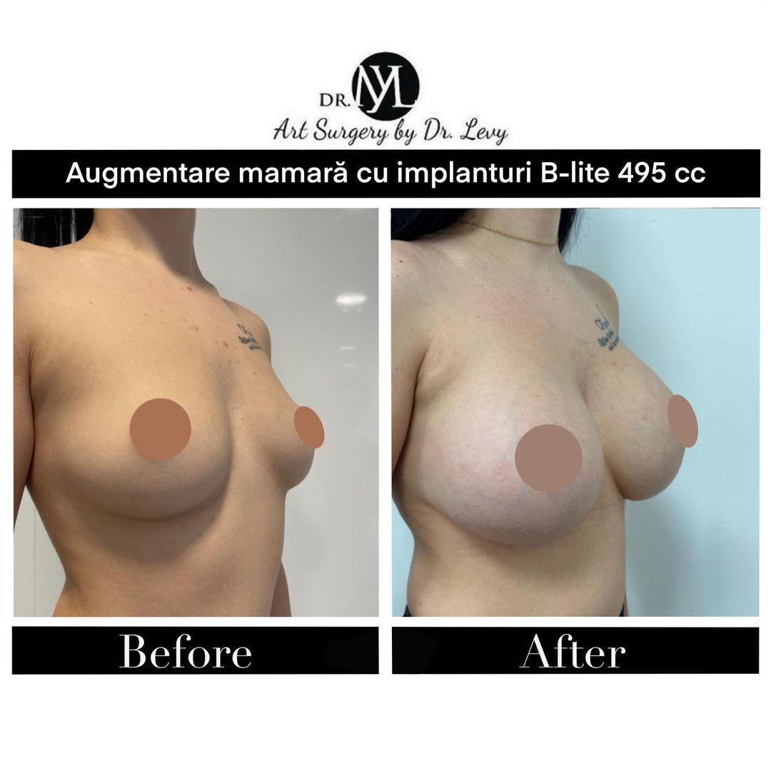 imagini implant mamar