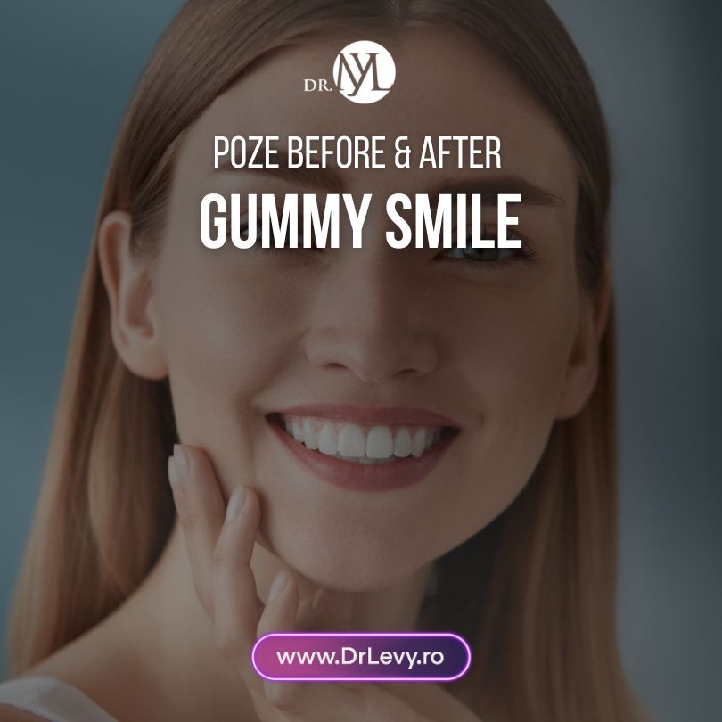 before and after gummy smile correction surgery